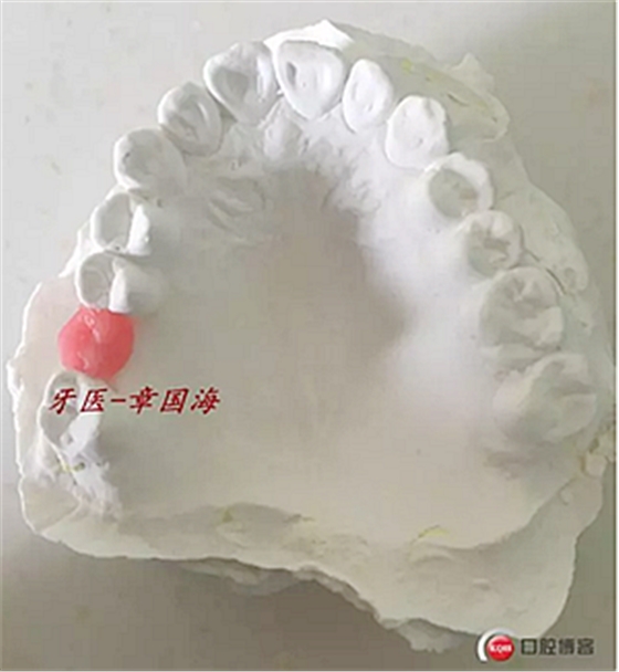 種植導(dǎo)板制作 種植導(dǎo)板制作