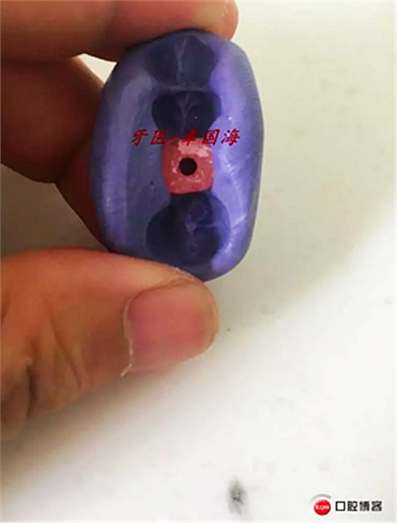 種植導(dǎo)板制作 種植導(dǎo)板制作