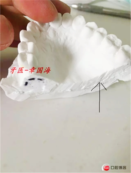 種植導(dǎo)板制作 種植導(dǎo)板制作