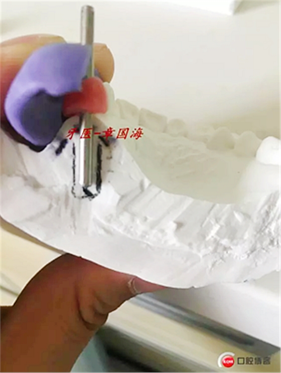 種植導(dǎo)板制作 種植導(dǎo)板制作