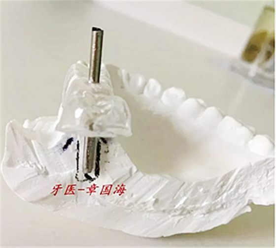 種植導(dǎo)板制作 種植導(dǎo)板制作