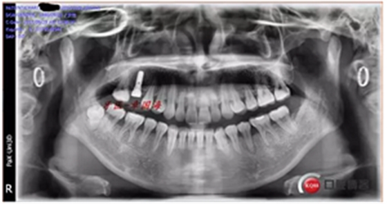 種植導(dǎo)板制作 種植導(dǎo)板制作