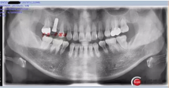 種植導(dǎo)板制作 種植導(dǎo)板制作