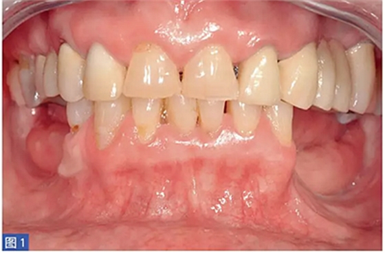 柵欄技術(shù)用于局部三維骨增量 —技術(shù)概述與病例匯報(bào) (1) 柵欄技術(shù)用于局部三維骨增量 —技術(shù)概述與病例匯報(bào) (1)