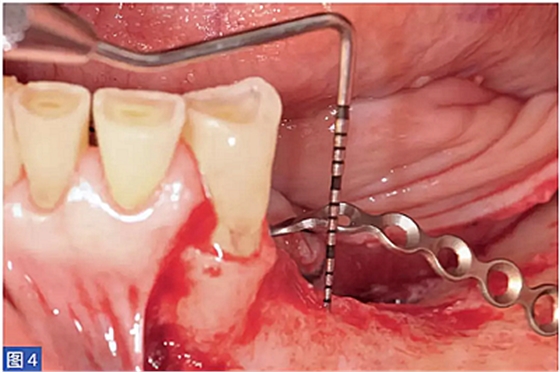 柵欄技術(shù)用于局部三維骨增量 —技術(shù)概述與病例匯報(bào) (1) 柵欄技術(shù)用于局部三維骨增量 —技術(shù)概述與病例匯報(bào) (1)