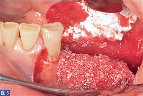 柵欄技術(shù)用于局部三維骨增量 —技術(shù)概述與病例匯報(bào) (1) 柵欄技術(shù)用于局部三維骨增量 —技術(shù)概述與病例匯報(bào) (1)