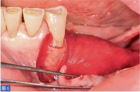 柵欄技術(shù)用于局部三維骨增量 —技術(shù)概述與病例匯報(bào) (1) 柵欄技術(shù)用于局部三維骨增量 —技術(shù)概述與病例匯報(bào) (1)