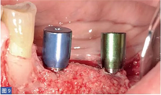 柵欄技術(shù)用于局部三維骨增量 —技術(shù)概述與病例匯報(bào) (1) 柵欄技術(shù)用于局部三維骨增量 —技術(shù)概述與病例匯報(bào) (1)