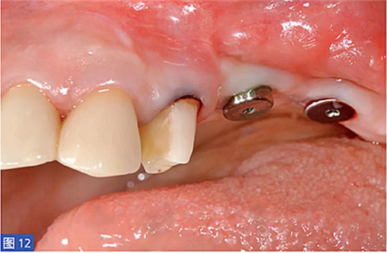柵欄技術(shù)用于局部三維骨增量 —技術(shù)概述與病例匯報(bào) (1) 柵欄技術(shù)用于局部三維骨增量 —技術(shù)概述與病例匯報(bào) (1)