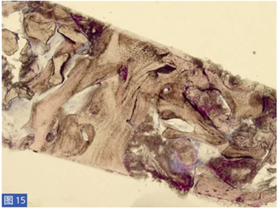 柵欄技術(shù)用于局部三維骨增量 —技術(shù)概述與病例匯報(bào) (2) 柵欄技術(shù)用于局部三維骨增量 —技術(shù)概述與病例匯報(bào) (2)