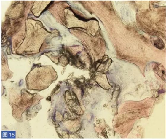 柵欄技術(shù)用于局部三維骨增量 —技術(shù)概述與病例匯報(bào) (2) 柵欄技術(shù)用于局部三維骨增量 —技術(shù)概述與病例匯報(bào) (2)