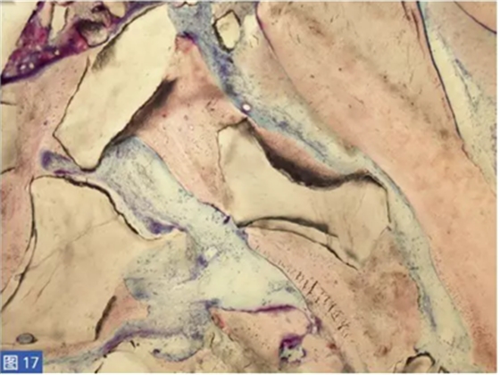 柵欄技術(shù)用于局部三維骨增量 —技術(shù)概述與病例匯報(bào) (2) 柵欄技術(shù)用于局部三維骨增量 —技術(shù)概述與病例匯報(bào) (2)