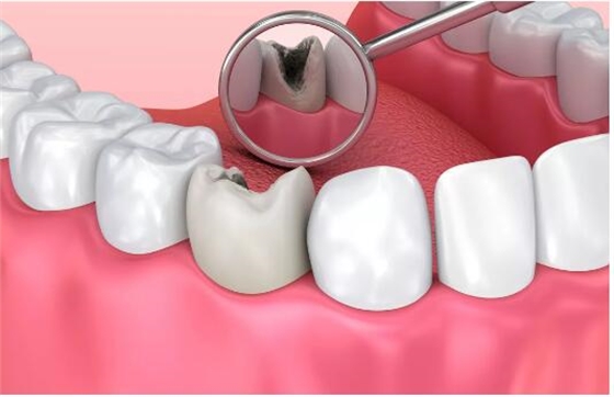 「斬牙除根」or 保留「殘骸」？