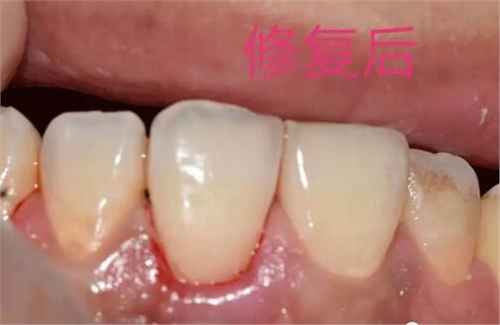 什么是牙齒楔缺？