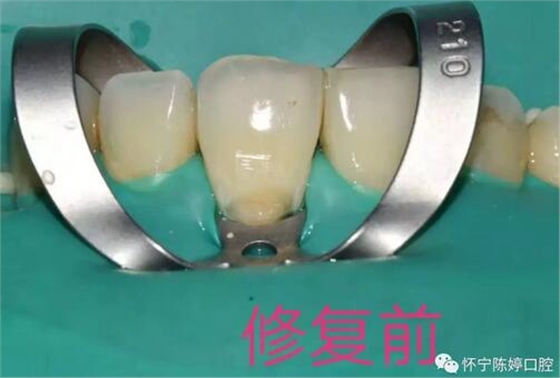 什么是牙齒楔缺？