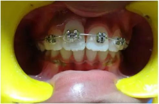 文獻(xiàn)綜述|年輕恒牙挫入脫位的多學(xué)科治療 文獻(xiàn)綜述|年輕恒牙挫入脫位的多學(xué)科治療