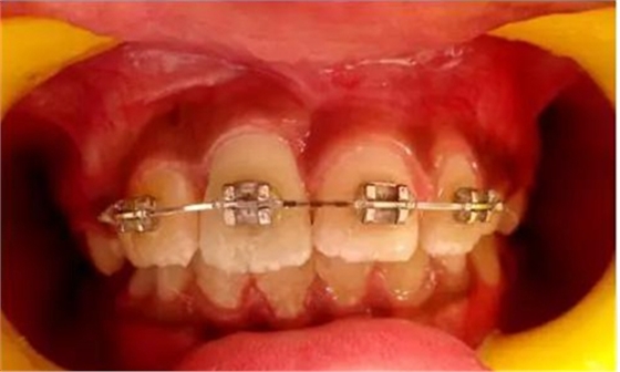 文獻(xiàn)綜述|年輕恒牙挫入脫位的多學(xué)科治療 文獻(xiàn)綜述|年輕恒牙挫入脫位的多學(xué)科治療