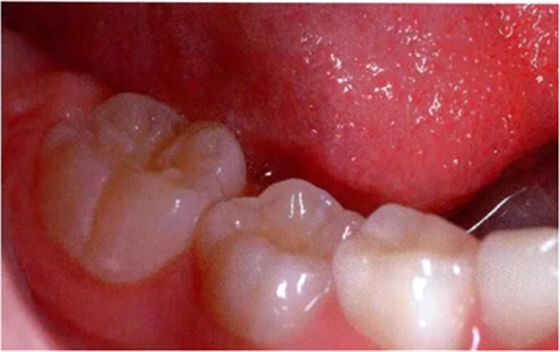 文獻(xiàn)直達(dá)|乳磨牙下沉的臨床管理 文獻(xiàn)直達(dá)|乳磨牙下沉的臨床管理