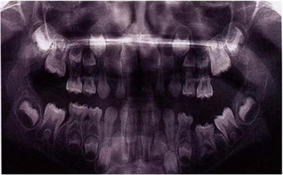 文獻(xiàn)直達(dá)|乳磨牙下沉的臨床管理 文獻(xiàn)直達(dá)|乳磨牙下沉的臨床管理
