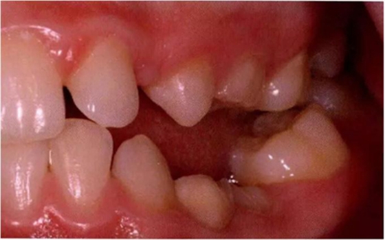 文獻(xiàn)直達(dá)|乳磨牙下沉的臨床管理 文獻(xiàn)直達(dá)|乳磨牙下沉的臨床管理