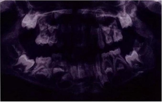 文獻(xiàn)直達(dá)|乳磨牙下沉的臨床管理 文獻(xiàn)直達(dá)|乳磨牙下沉的臨床管理