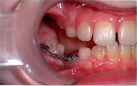 文獻(xiàn)直達(dá)|乳磨牙下沉的臨床管理 文獻(xiàn)直達(dá)|乳磨牙下沉的臨床管理