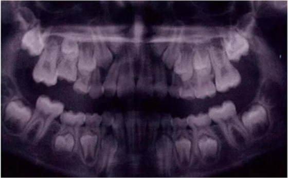 文獻(xiàn)直達(dá)|乳磨牙下沉的臨床管理 文獻(xiàn)直達(dá)|乳磨牙下沉的臨床管理