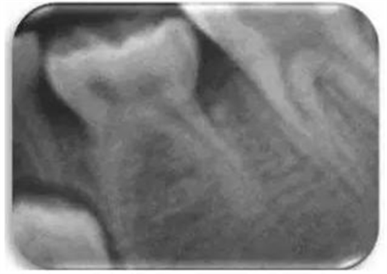 文獻(xiàn)直達(dá)｜一項(xiàng)西班牙的研究：低位乳磨牙的發(fā)生頻率、程度、牙根吸收和前磨牙發(fā)育不全情況