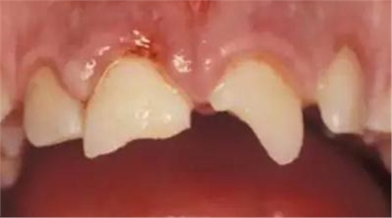 臨床實踐|乳牙外傷處理指引(值得兒牙醫(yī)生收藏) 臨床實踐|乳牙外傷處理指引(值得兒牙醫(yī)生收藏)