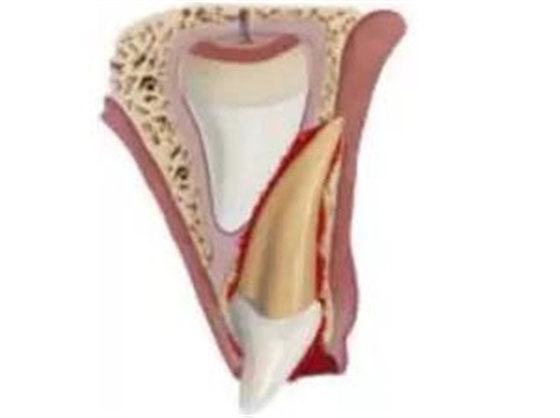 臨床實踐|乳牙外傷處理指引(值得兒牙醫(yī)生收藏) 臨床實踐|乳牙外傷處理指引(值得兒牙醫(yī)生收藏)