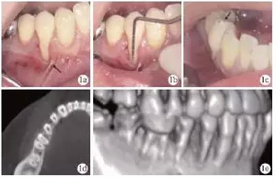 側(cè)向轉(zhuǎn)位瓣結(jié)合上皮下結(jié)締組織移植治療重度MillerⅢ°牙齦退縮1例 側(cè)向轉(zhuǎn)位瓣結(jié)合上皮下結(jié)締組織移植治療重度MillerⅢ°牙齦退縮1例