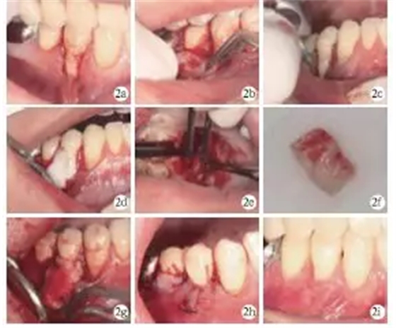 側(cè)向轉(zhuǎn)位瓣結(jié)合上皮下結(jié)締組織移植治療重度MillerⅢ°牙齦退縮1例 側(cè)向轉(zhuǎn)位瓣結(jié)合上皮下結(jié)締組織移植治療重度MillerⅢ°牙齦退縮1例