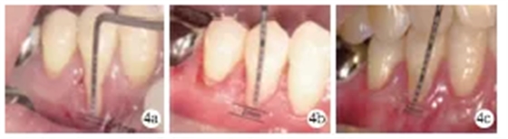 側(cè)向轉(zhuǎn)位瓣結(jié)合上皮下結(jié)締組織移植治療重度MillerⅢ°牙齦退縮1例 側(cè)向轉(zhuǎn)位瓣結(jié)合上皮下結(jié)締組織移植治療重度MillerⅢ°牙齦退縮1例