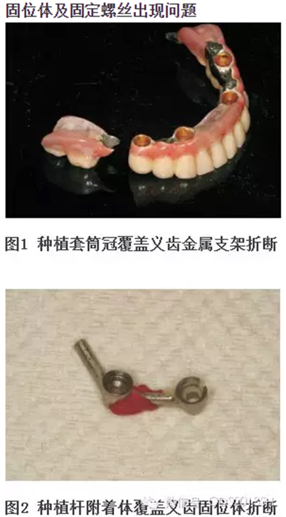 【經(jīng)驗分享】無牙頜種植修復(fù)固位的并發(fā)癥與處理——宋應(yīng)亮教授 【經(jīng)驗分享】無牙頜種植修復(fù)固位的并發(fā)癥與處理——宋應(yīng)亮教授