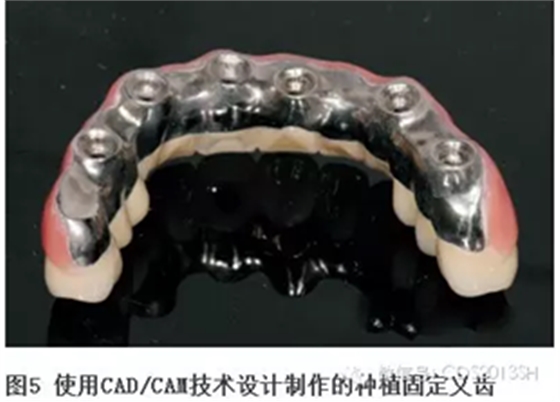 【經(jīng)驗分享】無牙頜種植修復(fù)固位的并發(fā)癥與處理——宋應(yīng)亮教授 【經(jīng)驗分享】無牙頜種植修復(fù)固位的并發(fā)癥與處理——宋應(yīng)亮教授