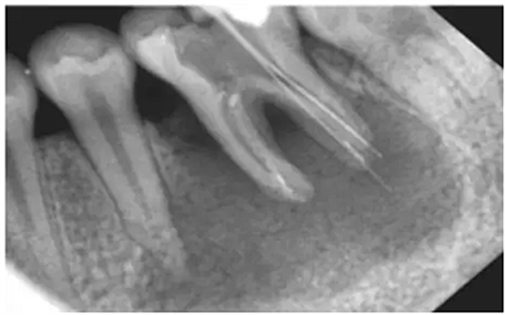 廠家來(lái)解說(shuō):多頻技術(shù)的根管長(zhǎng)度測(cè)定儀 廠家來(lái)解說(shuō):多頻技術(shù)的根管長(zhǎng)度測(cè)定儀