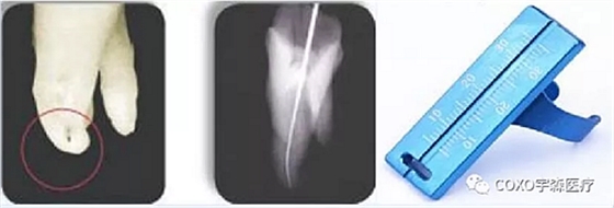 多頻技術(shù)的根管長(zhǎng)度測(cè)定儀 多頻技術(shù)的根管長(zhǎng)度測(cè)定儀