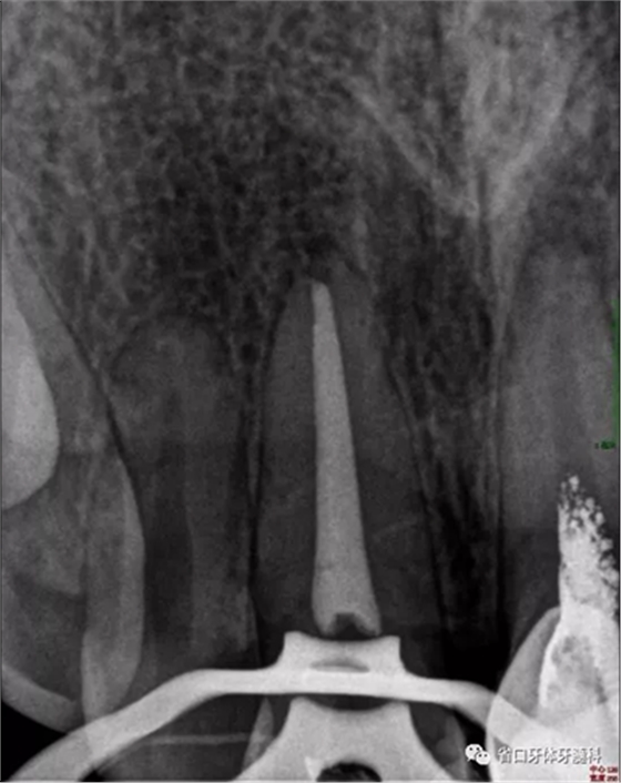上前牙根管再治療后內(nèi)漂白1例 上前牙根管再治療后內(nèi)漂白1例