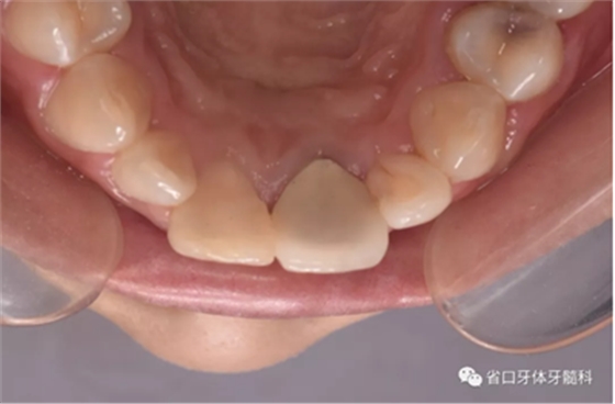 上前牙根管再治療后內(nèi)漂白1例 上前牙根管再治療后內(nèi)漂白1例