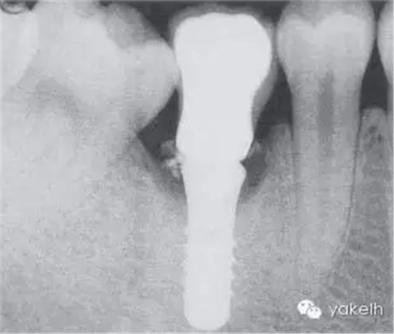 種植失敗的原因 種植失敗的原因