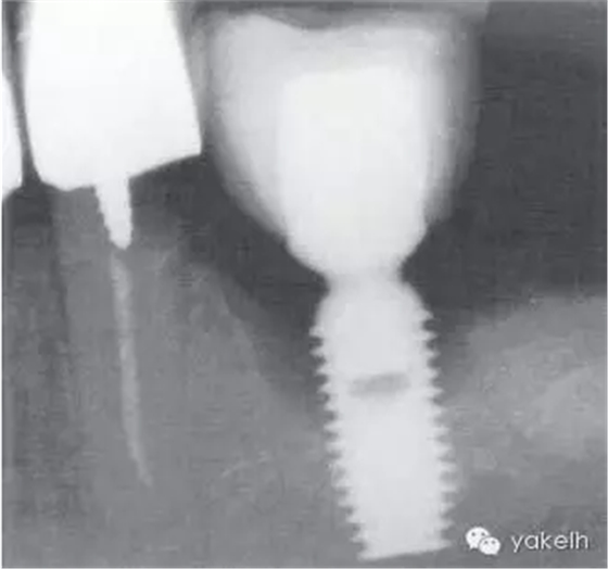 種植失敗的原因 種植失敗的原因