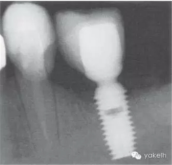 種植失敗的原因 種植失敗的原因