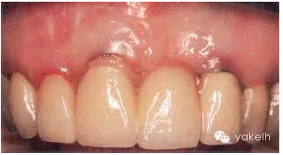 種植失敗的原因 種植失敗的原因