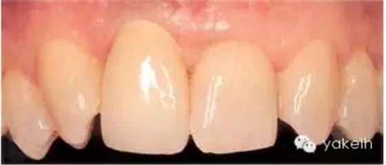 種植失敗的原因 種植失敗的原因