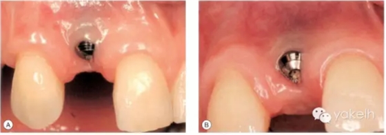 種植失敗的原因 種植失敗的原因