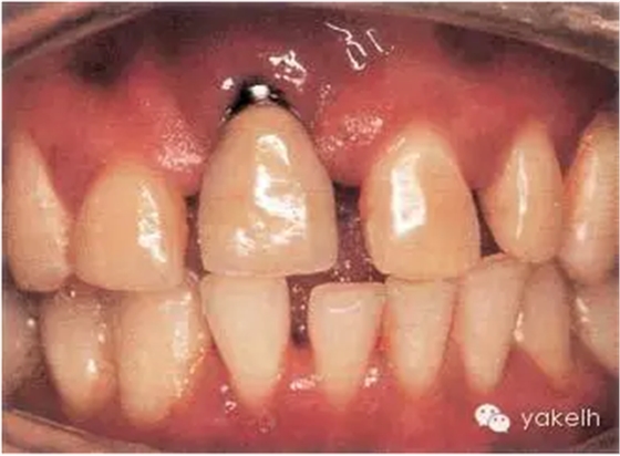 種植失敗的原因 種植失敗的原因