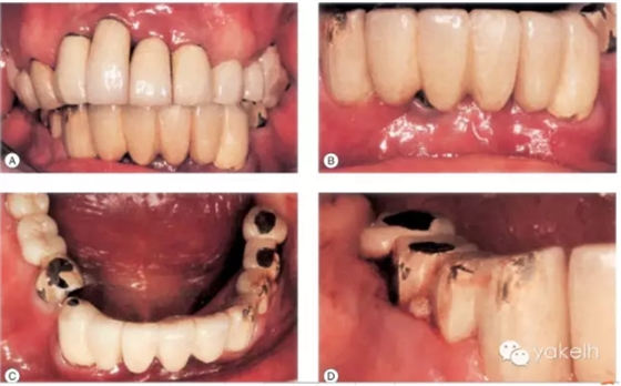 種植失敗的原因 種植失敗的原因