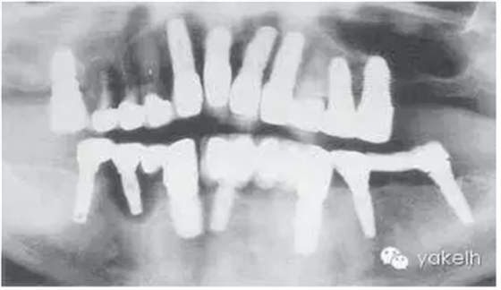 種植失敗的原因 種植失敗的原因