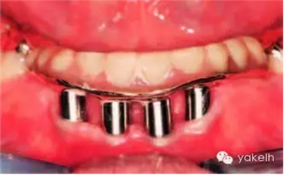 種植失敗的原因 種植失敗的原因