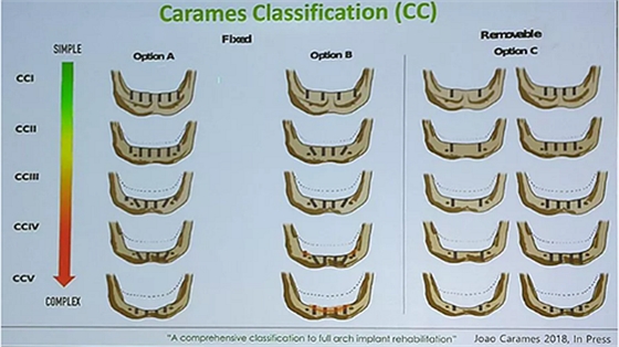 【熱點(diǎn)回顧】帶您深度了解無牙頜種植修復(fù)——Pro Arch 【熱點(diǎn)回顧】帶您深度了解無牙頜種植修復(fù)——Pro Arch